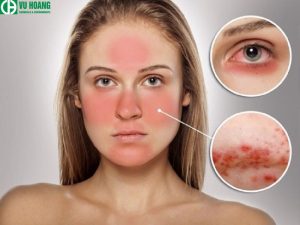 Axit Stearic có khả năng ngăn ngừa và phục hồi tổn thương da do vi khuẩn hoặc nhiễm trùng gây ra