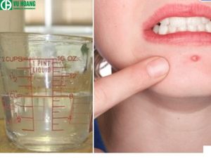 Ứng dụng trong điều trị mụn