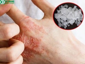 Cẩn thận khi sử dụng xút NaOH