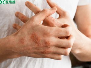 Javen có độc hại hay nguy hiểm không?