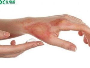 Sử dụng cẩn thận để tránh làm bỏng da