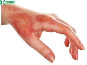 Cẩn thận khi sử dụng để tránh bị bỏng